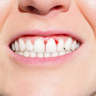 Gum Bleeding Treatment Cost in Dubai & Abu Dhabi