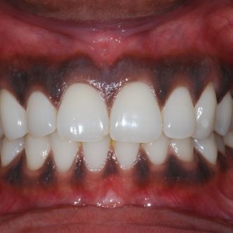 Gum Depigmentation Cost in Dubai & Abu Dhabi