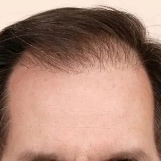 Hair Transplant Charges in Dubai & Abu Dhabi