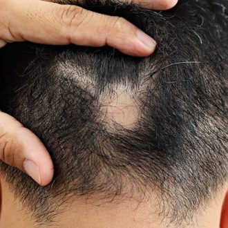 Hair Transplant for Genetic Hair Loss