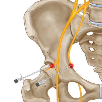 Hip Resurfacing for Women in Dubai & Abu Dhabi