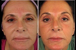 How Many best clinic of PRP Treatments Are Needed for Face Dubai