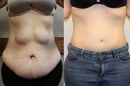 How Much Best Weight Do you Lose with Liposuction Dubai
