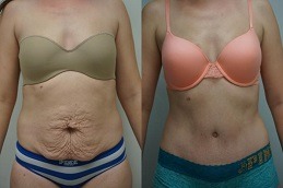 How Much Best Weight Do you Lose with Liposuction in Dubai