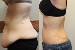 How Much Weight Do you Lose with Liposuction Dubai