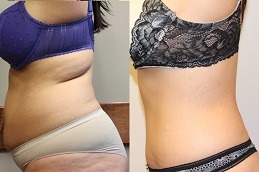 How Much Weight Do you Lose with Liposuction in Dubai