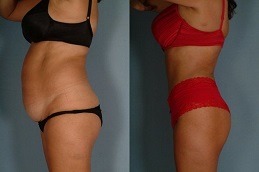 How Much best clinic of Weight Do you Lose with Liposuction Dubai
