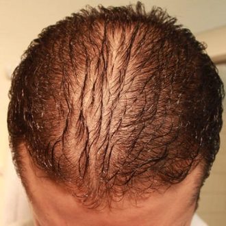 How to Stop Hair Fall in Dubai & Abu Dhabi