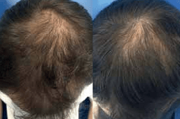 How to Stop best Hair Fall in Dubai & Abu Dhabi