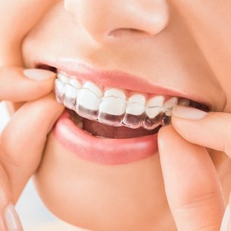 Invisalign Braces Treatment Cost in Dubai
