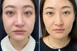 Is There a Procedure to Remove Fat From Face in Dubai