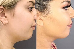 Is There a best Procedure to Remove Fat From Face in Dubai