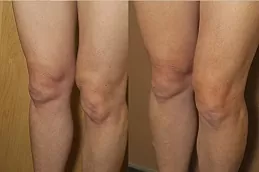 J Plasma for Thighs and Arms Dubai