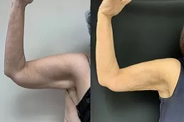 J Plasma for Thighs and Arms in Dubai