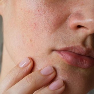 Large Pores Treatment 3 Proven Ways in Dubai