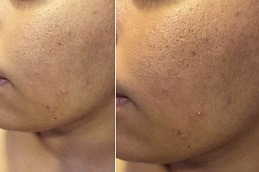 Large Pores Treatment by Dermatologist in Dubai