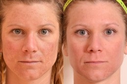 Melasma Dubai