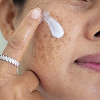 Melasma Treatment Cost in Dubai UAE