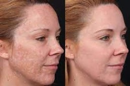 Melasma Treatment Dubai