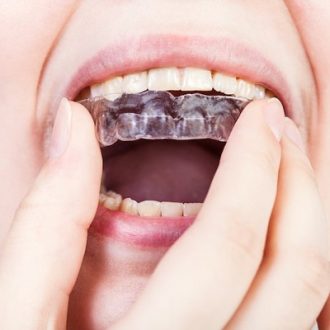 Mouthguard Cost in Dubai & Abu Dhabi