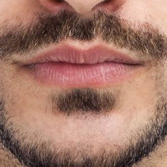 Mustache Hair Transplant: How Does it Work Dubai