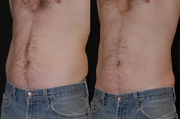 Non-Invasive Fat Removal Dubai