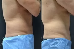 Non-Invasive Fat Removal in Dubai