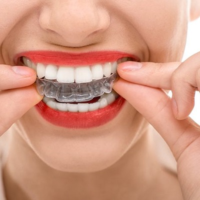 Overlapping Teeth Treatment Cost in Dubai