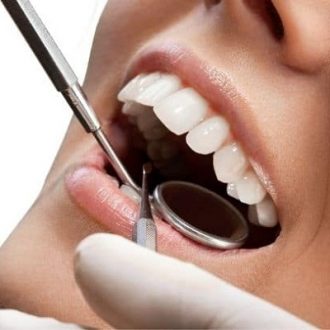 Porcelain Dental Veneers Cost in Dubai & Abu Dhabi