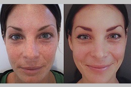 Salicylic Acid Peeling Dubai