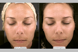Salicylic Acid Peeling in Dubai
