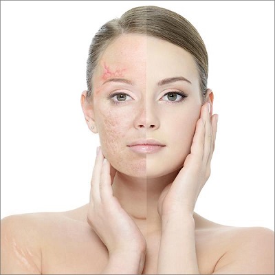 Scar Removal for Dark Skin in Dubai & Abu Dhabi Cost & Price