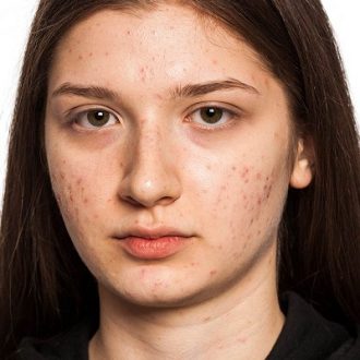 Scars Treatment for Hyperpigmentation in Dubai