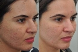 Skin Care Treatment Dubai