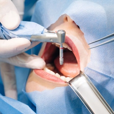 Titanium Implants Cost in Dubai & Abu Dhabi