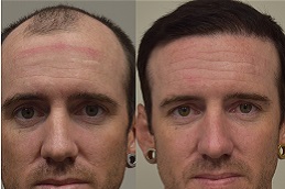 best hair-transplant-charges in dubai