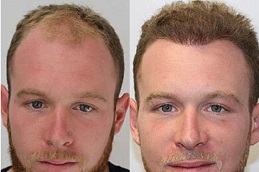 hair-transplant-charges in Abu Dhabi