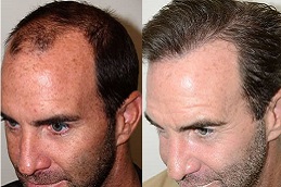 hair-transplant-charges in dubai