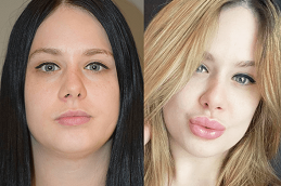 Best Lip Augmentation Cost in Abu Dhabi