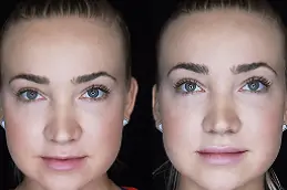 Best Lip Augmentation Cost in Dubai