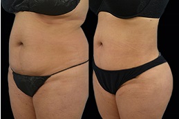 Best body-jet-liposuction-cost Clinic in Dubai