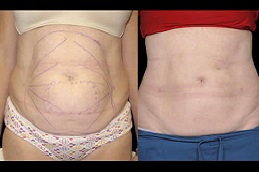 Best body-jet-liposuction-cost in Abu Dhabi