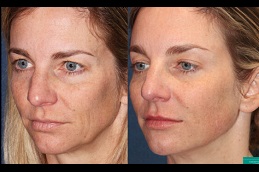 Best celebrity-who-done-botox-treatment clinic in Dubai