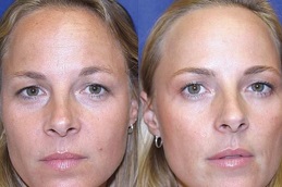 Best celebrity-who-done-botox-treatment in Abu Dhabi