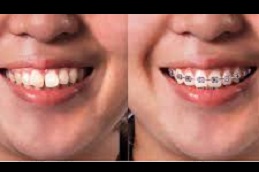 Best ceramic-braces-cost Clinic in Dubai