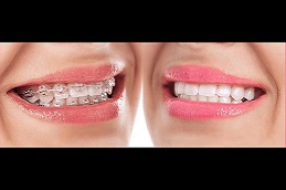 Best ceramic-braces-cost in Abu Dhabi