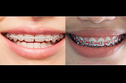 Best ceramic-braces-cost in Abu Dhabi
