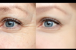 Best does-botox-work-for-wrinkles-around-the-mouth in Abu Dhabi