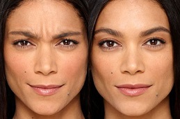 Best-does-botox-work-for-wrinkles-around-the-mouthClinic-in-Dubai.