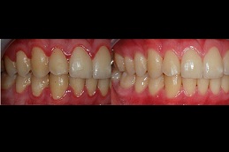 Best gingivitis-treatment-cost Clinic in Dubai